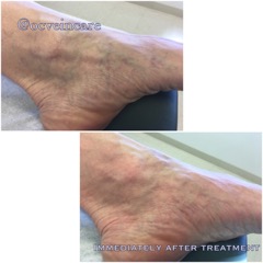 Small spider veins are common around the ankle area may give the appearance of a bluish discoloration or bruising. Treatment of spider veins with the VeinGogh is an excellent choice achieving an immediate result without any injectables.