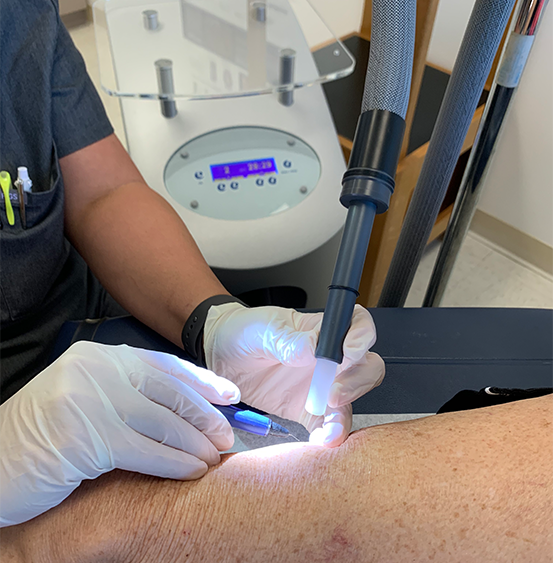 cryo-sclerotherapy
