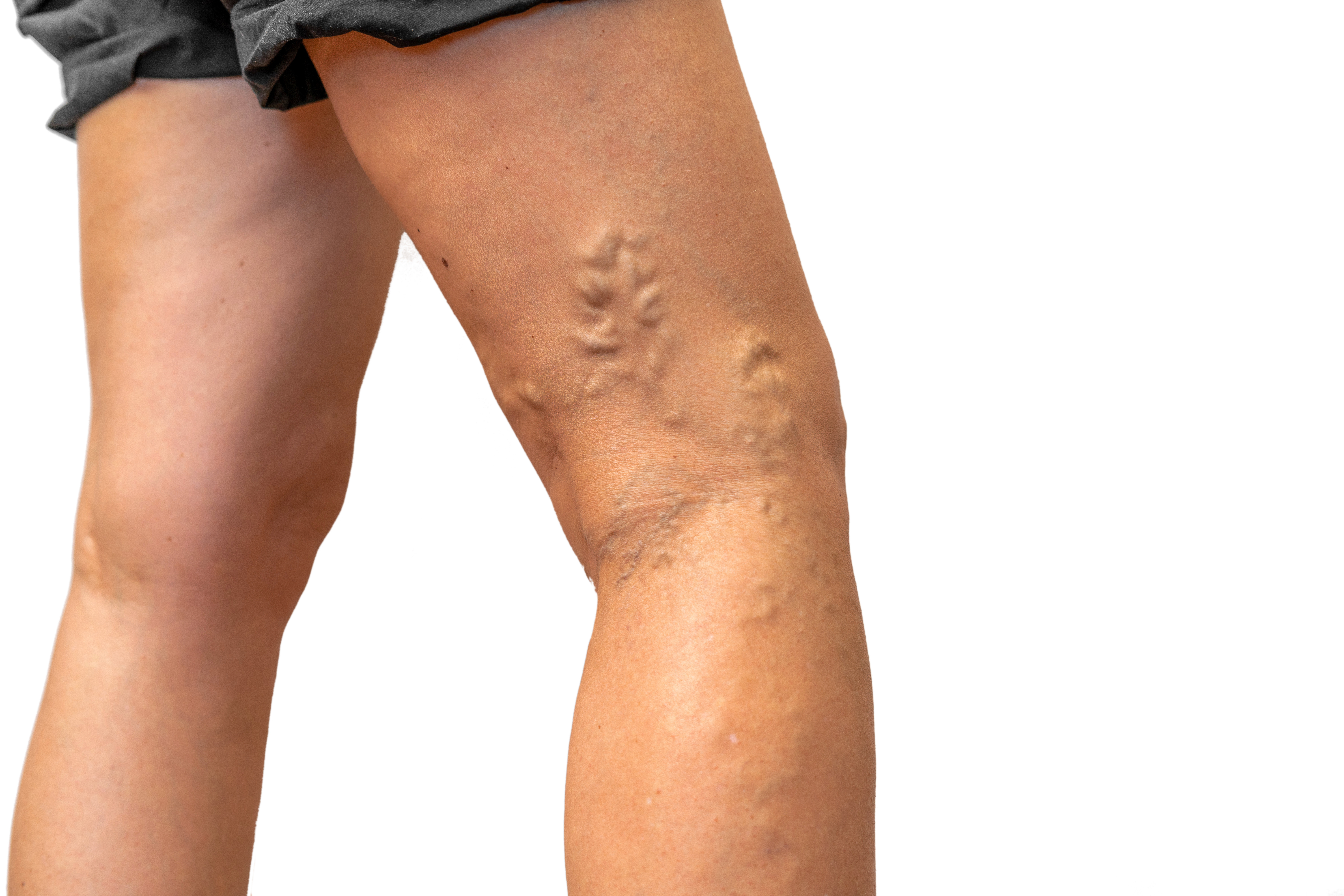 I have blue veins on my legs, are they varicose veins?