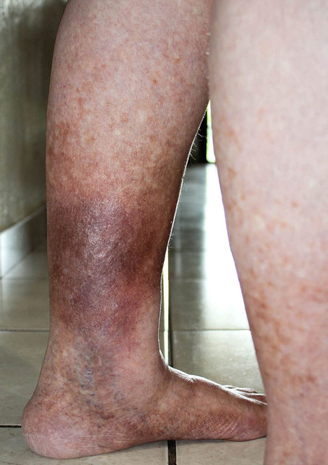 Venous Insufficiency Treatment Irvine, CA Laguna Woods, CA