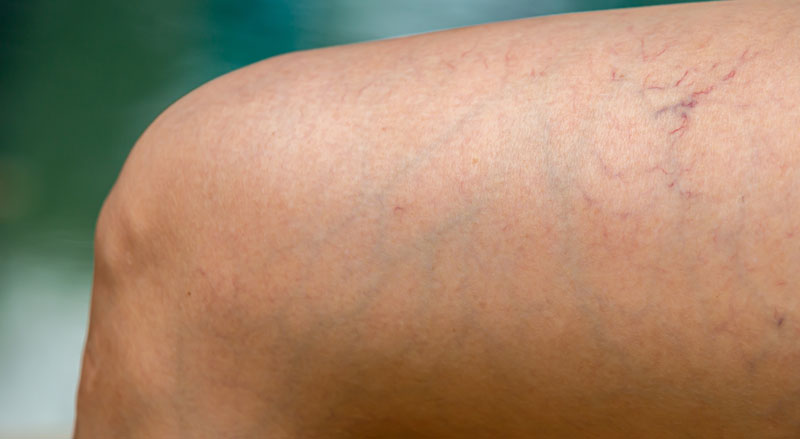 Sclerotherapy for Treatment for Spider Veins