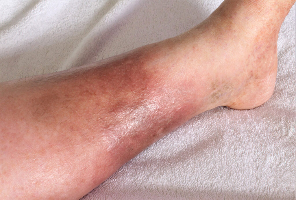 The Role of Venous Insufficiency in Leg Swelling