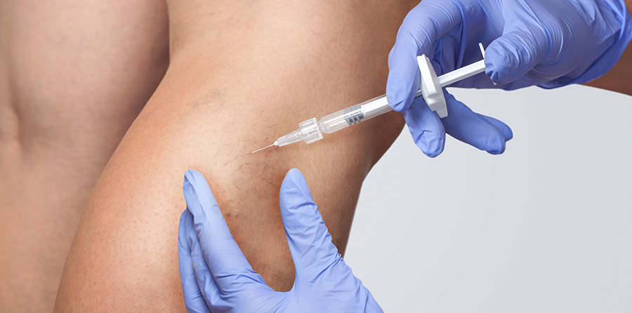 Vein Treatment: What to Expect During and After the Procedure